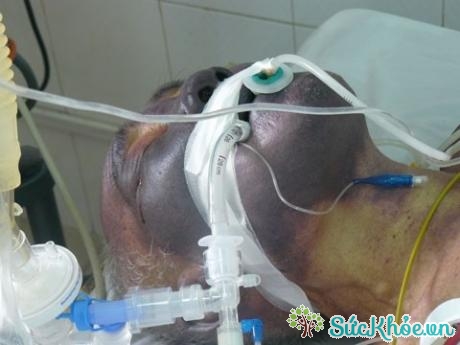 Ăn món ăn tái sống có nguy cơ nhiễm liên cầu khuẩn