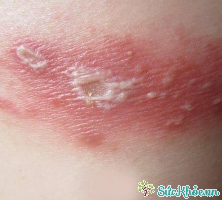 Kiến ba khoang đốt thường bị nhầm lẫn với bệnh ngoài da khác