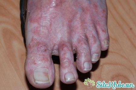 Nước ăn chân là một trong các bệnh về da thường gặp mùa mưa lũ