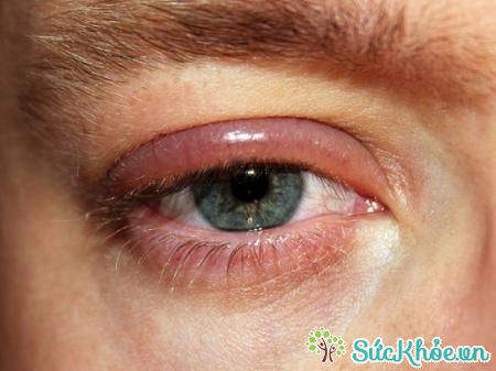 Nếu không được chữa trị kịp thời, đau mắt đỏ có thể gây mù lòa