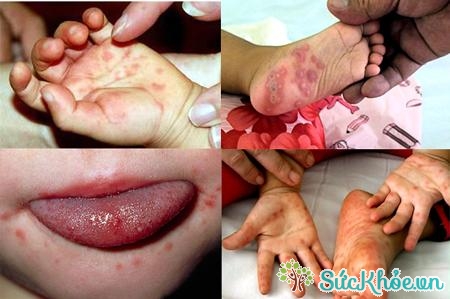 Trẻ em là đối tượng dễ bị bệnh tay chân miệng