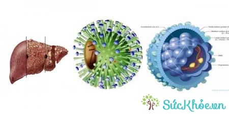 Bệnh viêm gan B do siêu vi HBV gây nên