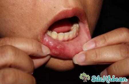 Tùy từng mức độ của bệnh mà có thuốc chữa nhiệt miệng khác nhau