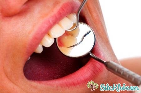 Nên đi khám răng thường xuyên để phòng bệnh viêm lợi