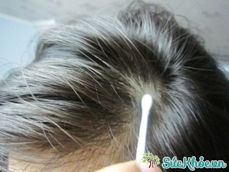 Sử dụng tăm bông để thoa dầu dừa lên tóc cũng là cách trị gàu hiệu quả