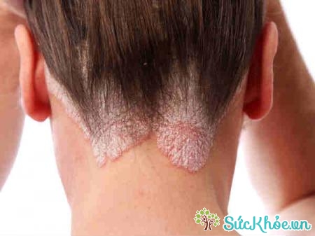 Nấm da đầu là một bệnh nhiễm trùng da gây ra bởi một loại nấm