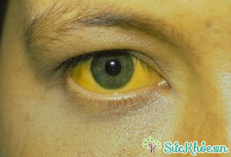 Người bị xơ gan có biểu hiện vàng da, vàng mắt