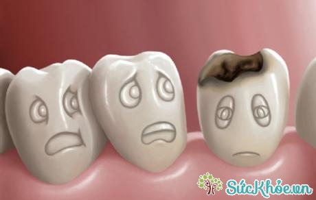 Hàm răng thô và yếu nên dễ bị tổn thương dẫn tới sâu răng