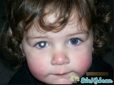 Bệnh đục thủy tinh thể ở trẻ em là bệnh lý thường gặp về các bệnh về mắt