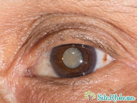 Bệnh đục thủy tinh thể làm giảm thị lực ở người bệnh, nặng có thể dẫn đến mù lòa