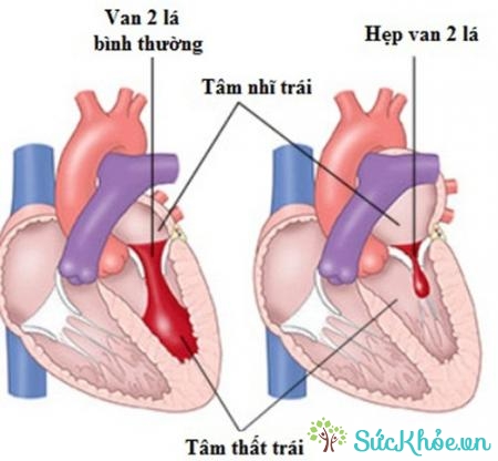 Bệnh van tim còn gọi là hở van tim