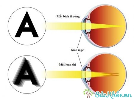 Bệnh loạn thị là bệnh về mắt thường gặp ở lứa tuổi học đường