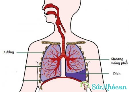 Viêm màng phổi có thể đi kèm tràn dịch màng phổi