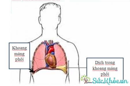 Những người có cơ địa không tốt dễ bị tràn dịch màng phổi