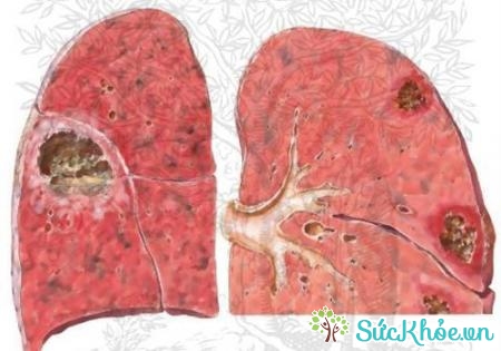 Áp-xe phổi là bệnh hô hấp thường gặp