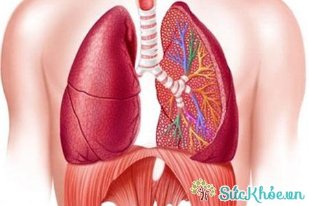 Nhồi máu ở phổi cũng có thể gây áp-xe phổi