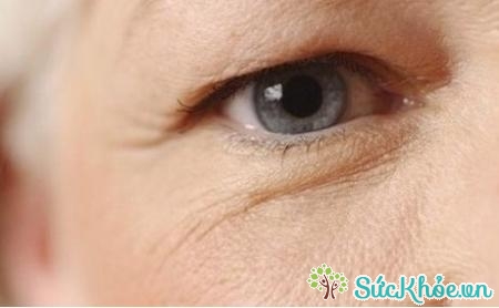Bệnh nhân có biểu hiện mắt bị quáng gà phần lớn là do thiếu vitamin A.