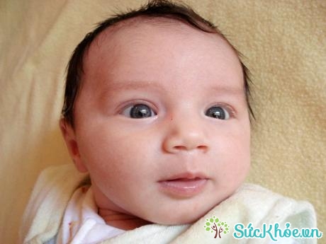 Biểu hiện bệnh lác mắt ở trẻ nhỏ là trẻ thường mỏi mắt, nhìn mờ và 2 mắt lệch nhau