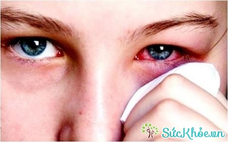 Bệnh viêm kết mạc có triệu chứng điển hình là cộm, ngứa và đỏ mắt