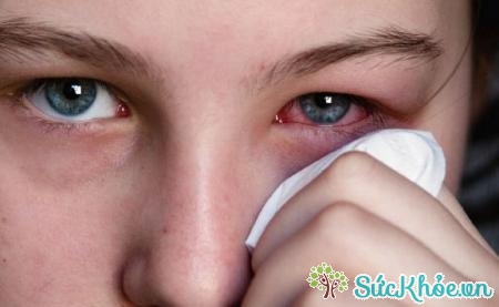 Người bệnh thấy ngứa và đỏ cả hai mắt, cộm mắt và chảy nước mắt nhiều