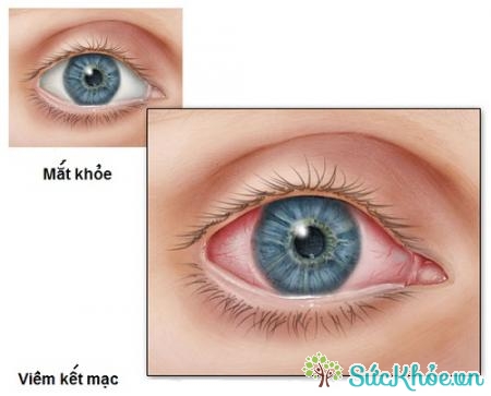 Bệnh viêm kết mạc mùa xuân là bệnh thường gặp ở mắt vào mùa xuân