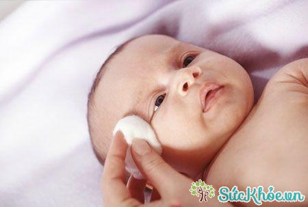 Khi bị viêm kết mạc sơ sinh, cả hai mi sưng nề, đỏ khiến trẻ khó mở mắt