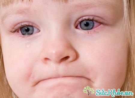 Viêm kết mạc còn được gọi đau mắt đỏ, bệnh thường xảy ra ở trẻ em