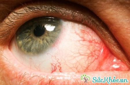 Triệu chứng viêm kết mạc mắt do virus là bệnh nhân thấy ngứa mắt và có thể chảy máu ở tròng trắng