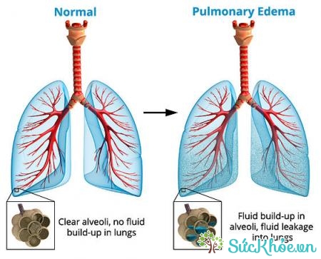 Nguyên nhân phù phổi cấp có thể do tăng huyết áp