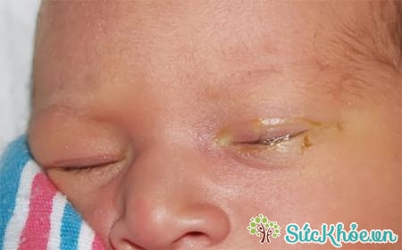 Viêm tắc tuyến lệ ở trẻ sơ sinh là căn bệnh khá phổ biến ở mắt