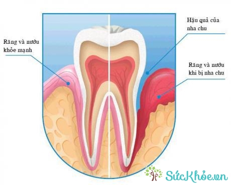 mất bám dính của lợi vào cổ răng là dấu hiệu thường thấy của bệnh nha chu