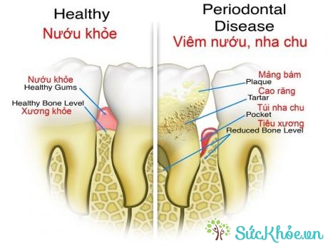 Bệnh nha chu do mảng bám răng có chứa vi khuẩn