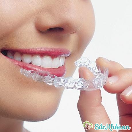 Sử dụng dụng cụ bảo vệ răng trong trường hợp nghiến răng quá nặng