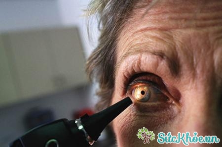 Glôcôm là bệnh lý có thể dẫn đến mất thị lực vĩnh viễn nếu không được điều trị kịp thời