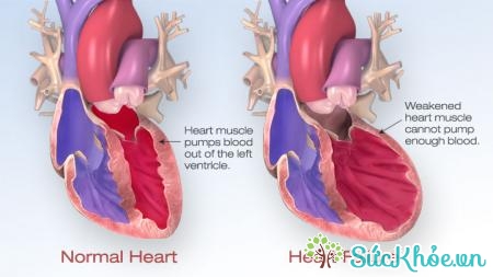Biến chứng nhồi máu cơ tim có thể gây suy tim