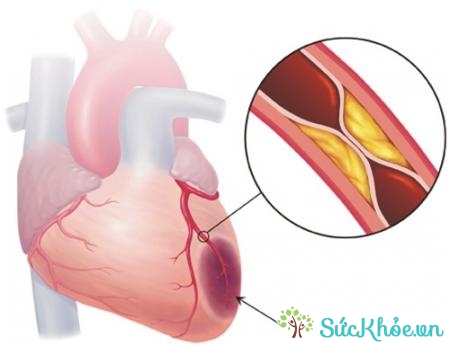 Nghẽn mạch vành cũng gây nhồi máu cơ tim