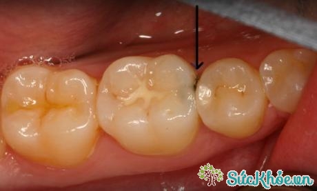 Răng ngả màu sẫm và có đốm trắng là dấu hiệu sâu răng đầu tiên của bệnh