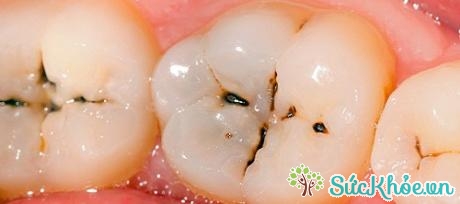 Khi răng đã chuyển sang thể sâu sẽ xuất hiện lỗ sâu trên răng