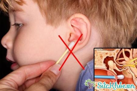 Vệ sinh tai không đúng cách cũng là nguyên nhân gây bệnh viêm tai ngoài