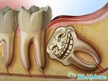 Răng không mọc lệch làm ảnh hưởng tới răng số 7