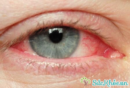 Nấm mắt là một trong những căn bệnh thường gặp về mắt