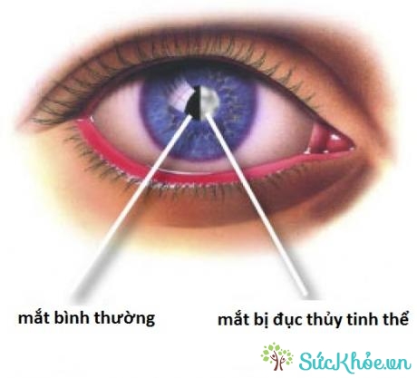 Mù màu do quá trình bị chấn thương ở mắt làm ảnh hưởng