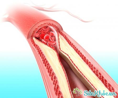 Hiện tượng tắc nghẽn động mạch cũng có thể dẫn đến bệnh động mạch vành