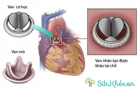 Sửa van tim là biện pháp phẫu thuật điều trị van tim