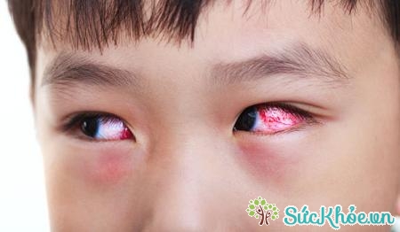 Nguyên nhân đau mắt đỏ ở trẻ nhỏ là là do chưa vệ sinh mắt đúng cách
