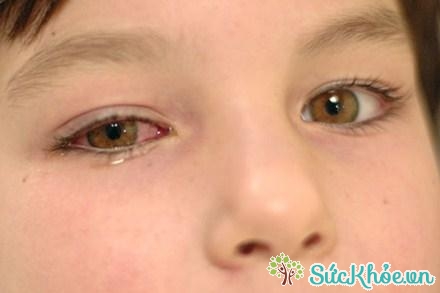 Nguyên nhân đau mắt đỏ do virut, vi khuẩn phần lớn là do người bệnh bị cảm lạnh