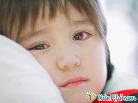 Nguyên nhân đau mắt đỏ ở trẻ em chủ yếu là do các tác nhân dị ứng