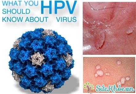 HPV_virus gây bệnh sùi mào gà