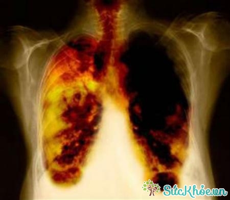 Xơ phổi là biến chứng áp-xe phổi phổ biến
