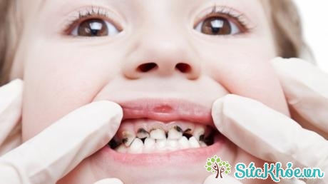 Điều trị sâu răng ở trẻ em là việc làm cần thiết 
